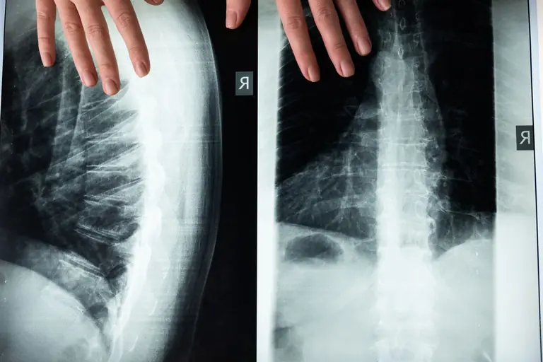 An illustrative close-up of a spine X-ray with hands, highlighting medical imaging and anatomy.